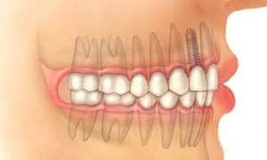 implantologia-dentale