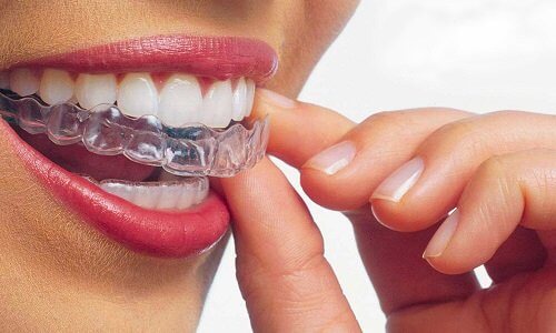 Ortodonzia classica e Invisalign