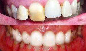 zirconio oral beauty
