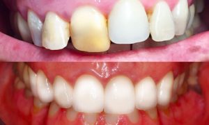 zirconio oral beauty