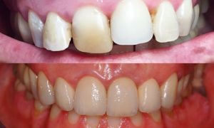 zirconio oral beauty