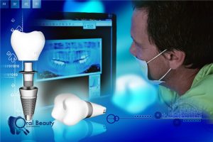 IMPIANTI DENTALI E CHIRURGIA GUIDATA_PER IL BENESSERE DEL PAZIENTE1