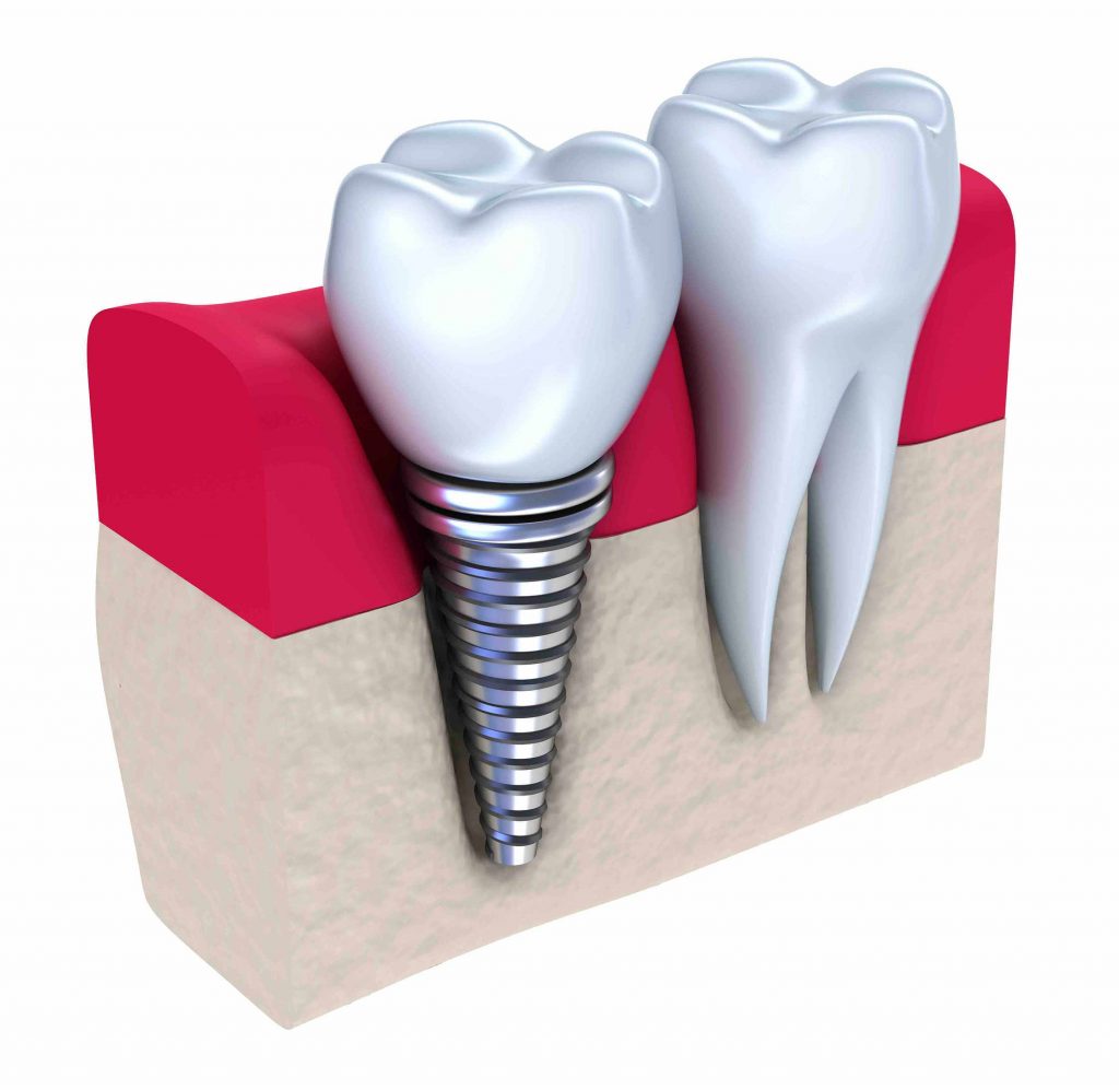 IMPIANTI DENTALI E CHIRURGIA GUIDATA_PER IL BENESSERE DEL PAZIENTE_2