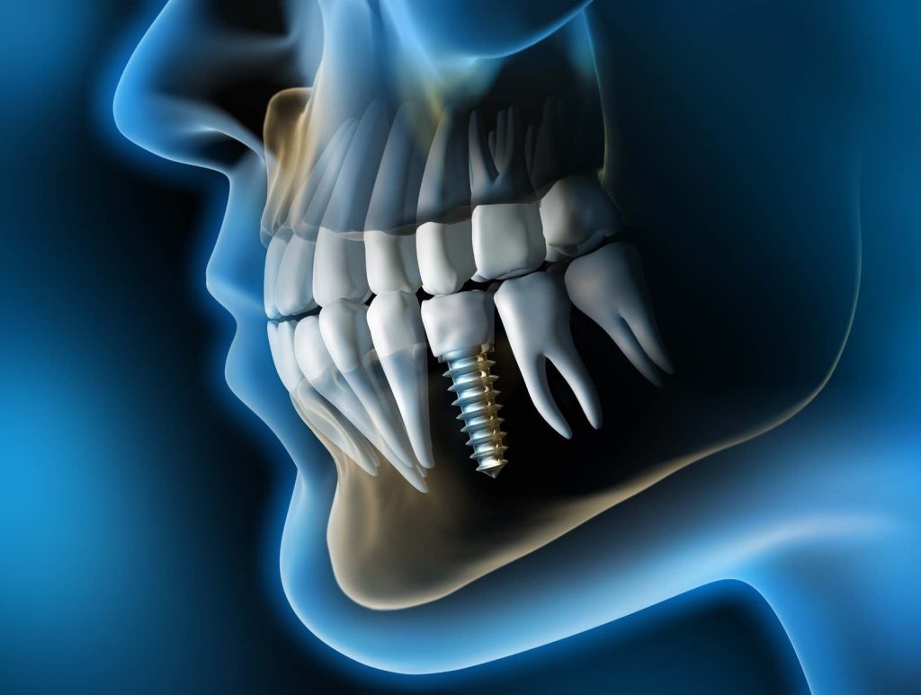 IMPIANTI DENTALI E CHIRURGIA GUIDATA_PER IL BENESSERE DEL PAZIENTE_3